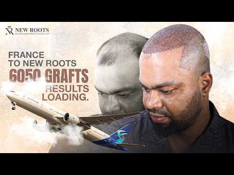 Grade 6 Baldness Brought Him From France to Dhaka! 😎 | 6000+ Grafts | Hair Transplant in Bangladesh
