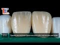 Прямая реставрация фронтального зуба: внутренняя анатомия