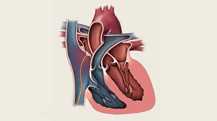 Mayo Clinic Minute: What you need to know about patent foramen ovale - DayDayNews