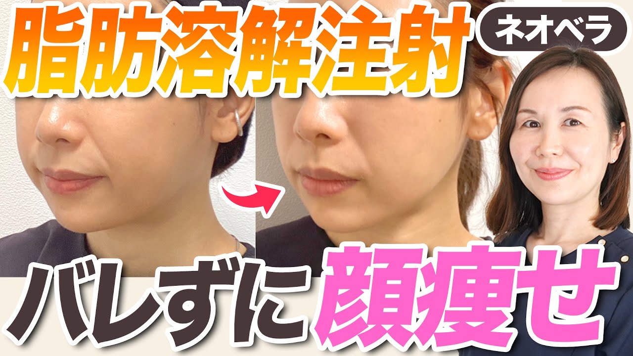 【顔痩せ】脂肪溶解注射、効果ある？痛みやダウンタイムも解説！