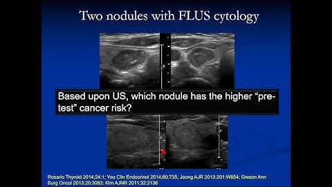 Thyroid Fine Needle Aspiration FNA and Cytology by Jill E  Langer, MD   SD