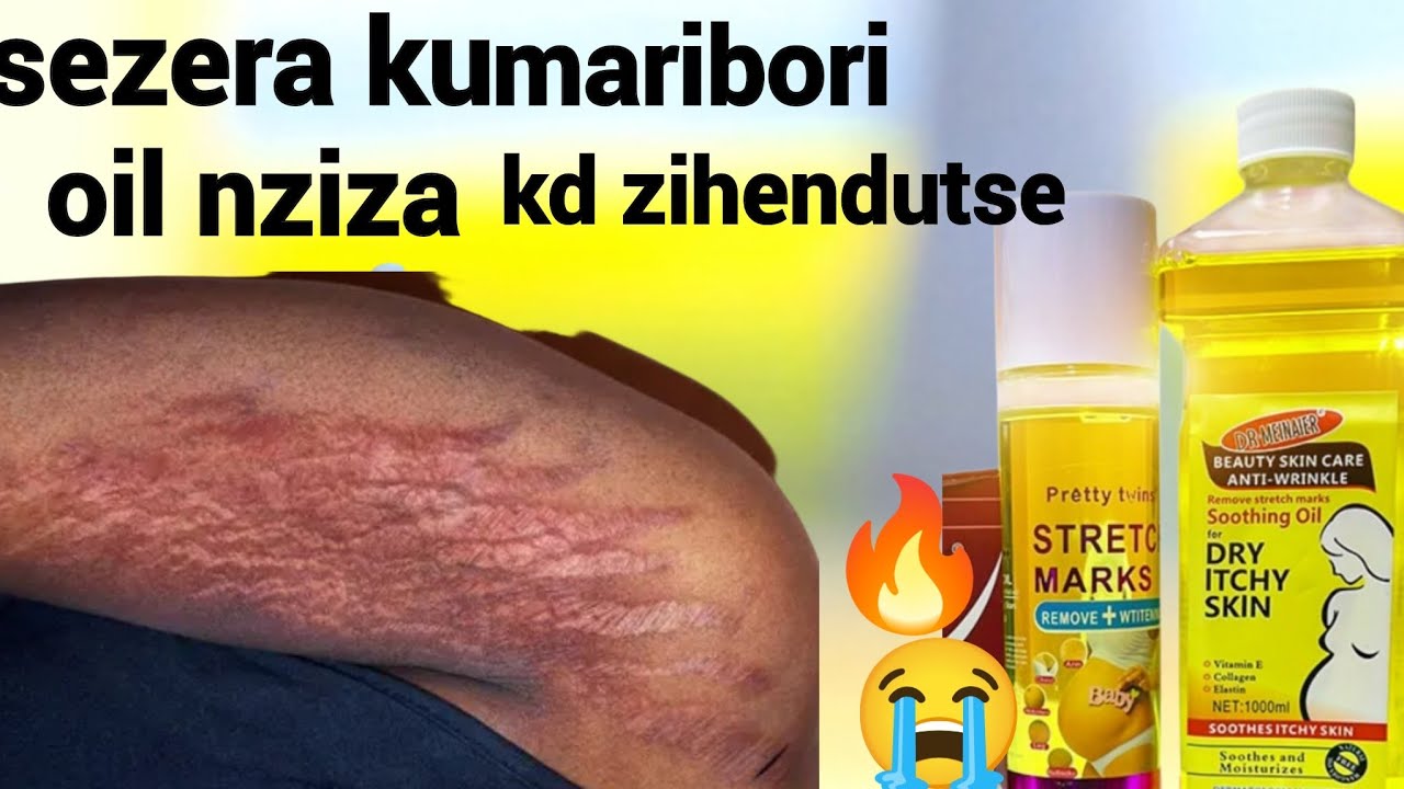 Вот масло, способное вылечить угревую сыпь любого вида. Вне зависимости от формы прыща, он исчезн...