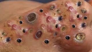 Loan Nguyen Acne Treatment 11y