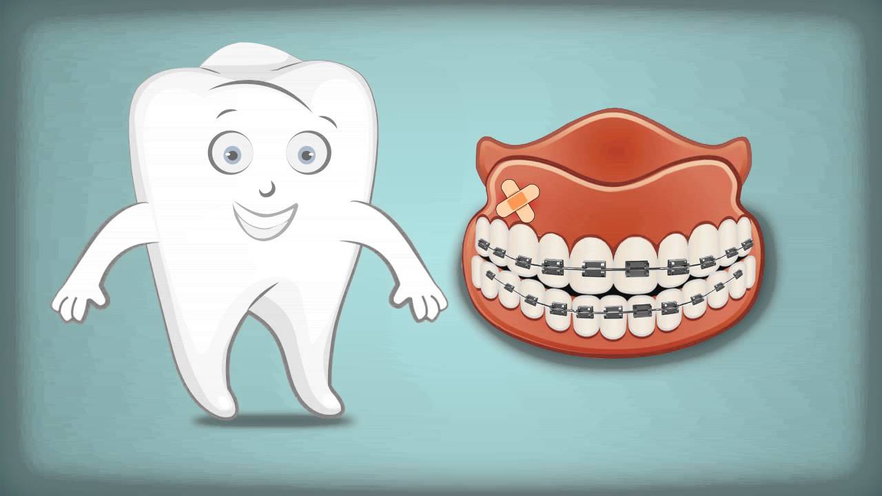 Mini Braces Spanish-Smile Stations