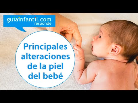 Sudamina y acné neonatal. Principales alteraciones de la piel del bebé | Guiainfantil responde