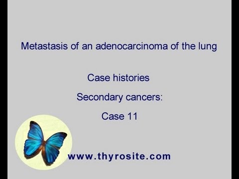 Metastasis of an