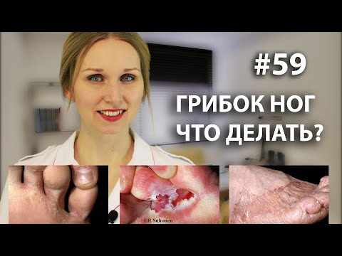ГРИБОК НОГ - ЧТО ДЕЛАТЬ? КАК ВЫЛЕЧИТЬ?