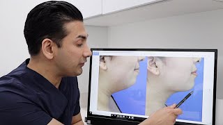 Mini Neck Lift provides beautiful results from Dr. Dass Beverly Hills