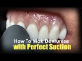 How to make dentures with perfect suction