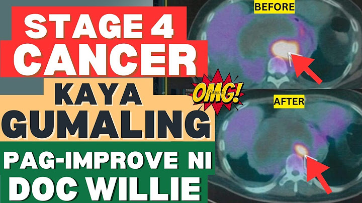 Stage 4 Cancer, Kaya Pa Gumaling.- By Doc Willie Ong