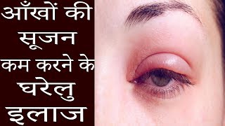 आंखों की सूजन खत्म करने के घरेलू उपाए  | Home Remedies For Puffy Eyes - Eye Bags Home Remedies