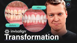 LIFE CHANGING Teeth Restoration! Impossible Transformation Solved with Invisalign Ep3