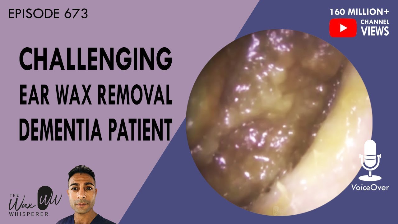 673 Challenging Ear Wax Removal Dementia Patient YouTube