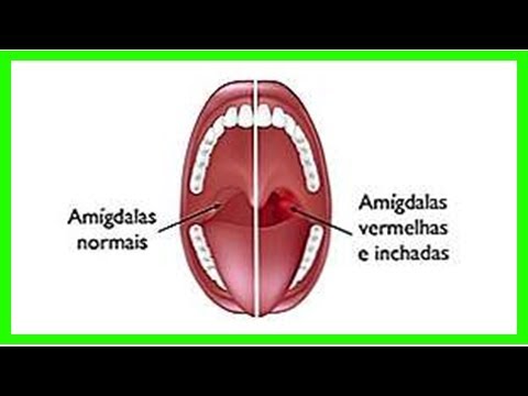 Symptome der Mononukleose