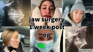 JAW SURGERY 1 Week Post Op Vlog