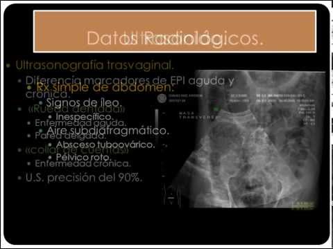 Vídeo: Anexitis Aguda: Causas, Síntomas Y Tratamiento De La Anexitis Aguda