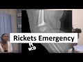 Rickets in the Pediatric Emergency Department