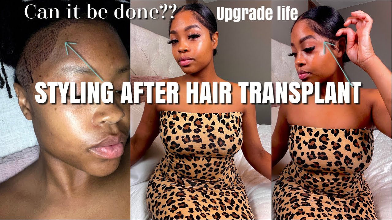 Life after hair transplant |what you should know | update 2021