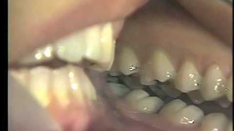 Occlusion: Balancing Interferences and Bruxism