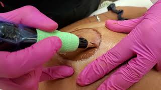 Nipple & Areola Tattooing