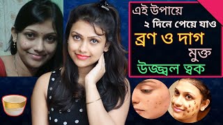 How To Remove Pimples Naturally | Pimple Removal Home Remedy (100% Works)
