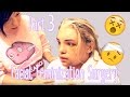 Facial Feminization Surgery - Day 5 & 6 (GRAPHIC) | Stef Sanjati