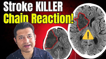 Stroke Kills in Cascades: Excitotoxicity, Oxidative Stress & Penumbra Explained!