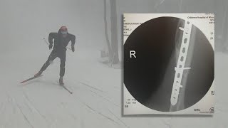 Teen skier pushes past surgeries, broken bones, wins team title | FOX6 News Milwaukee