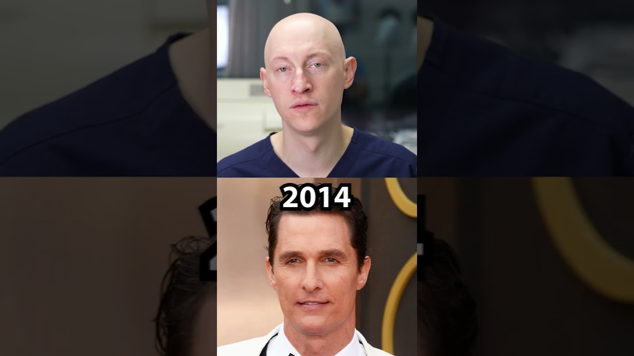 Did Matthew McConaughey have a Hair Transplant?