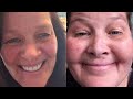Surviving Prednisone: The Real Cost &amp; How I Made It Through