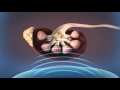 Shockwave Lithotripsy (SWL)