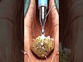 #anatomy kidney stones removeal