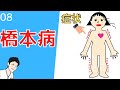 ⑧甲状腺機能低下症　どんな症状が起きるか？考え方はコチラ【看護師　薬剤師向け】