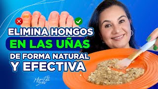 ELIMINA HONGOS EN LAS UÑAS DE FORMA NATURAL Y EFECTIVA