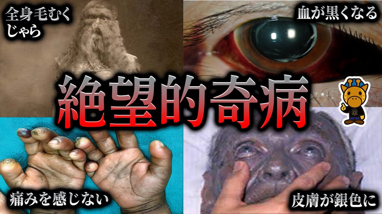 恐ろしい姿に変貌してしまう奇病4選 Youtube