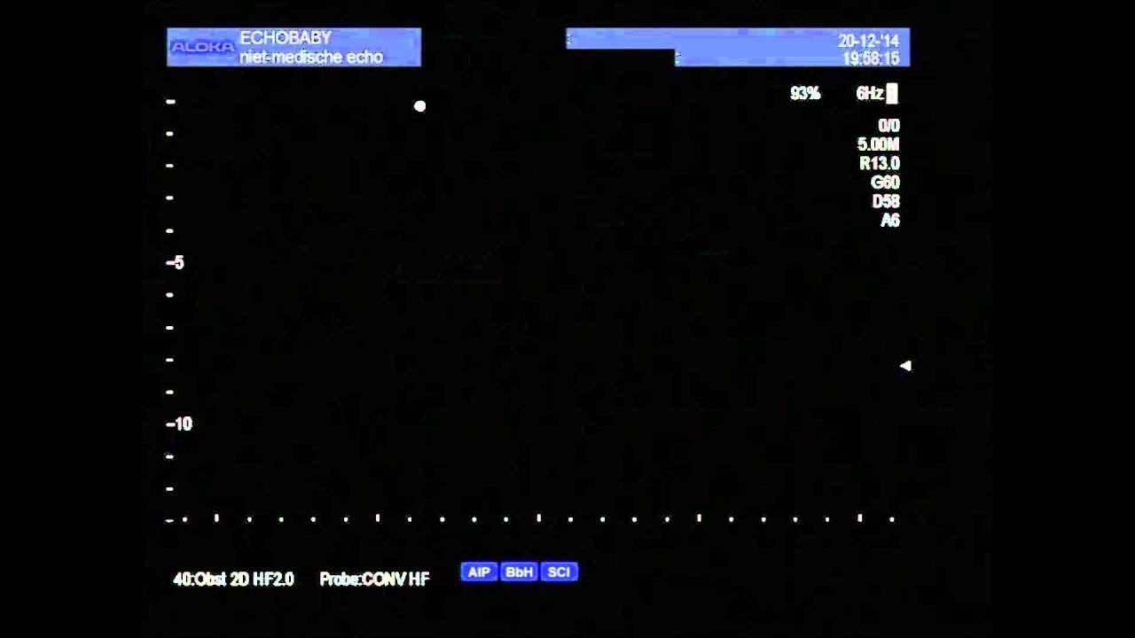 2D echo geslachtsbepaling 16 weken, met ingesproken uitleg