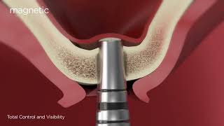Osseotouch Magnetic Mallet Sinus Lift