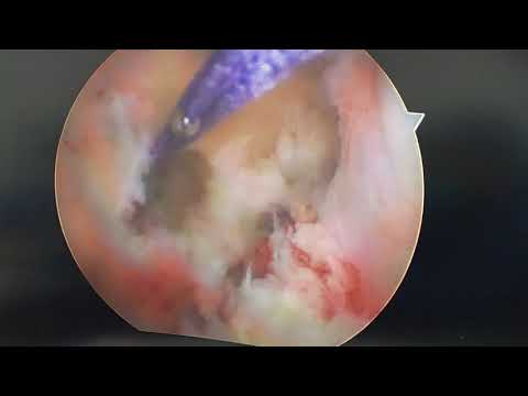 Anterior Cruciate Ligament Reconstruction Using Fixed Loop All Inside FLAI Technique
