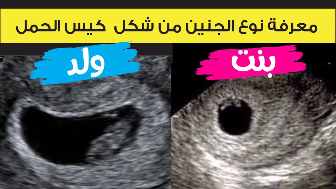 الفرق بين شكل كيس الحمل للجنين الذكر والجنين الانثي و ازاي تعرفي نوع الجنين من خلال صوره السونار