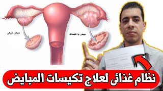 علاج تكيسات المبايض ،النظام الغذائى ، مقاومة الأنسولين الأسباب و العلاج