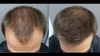 2901 Grafts. HT by FUE Technique. Early regrowth at 5 months. Injertocapilar.com.1819/2016.