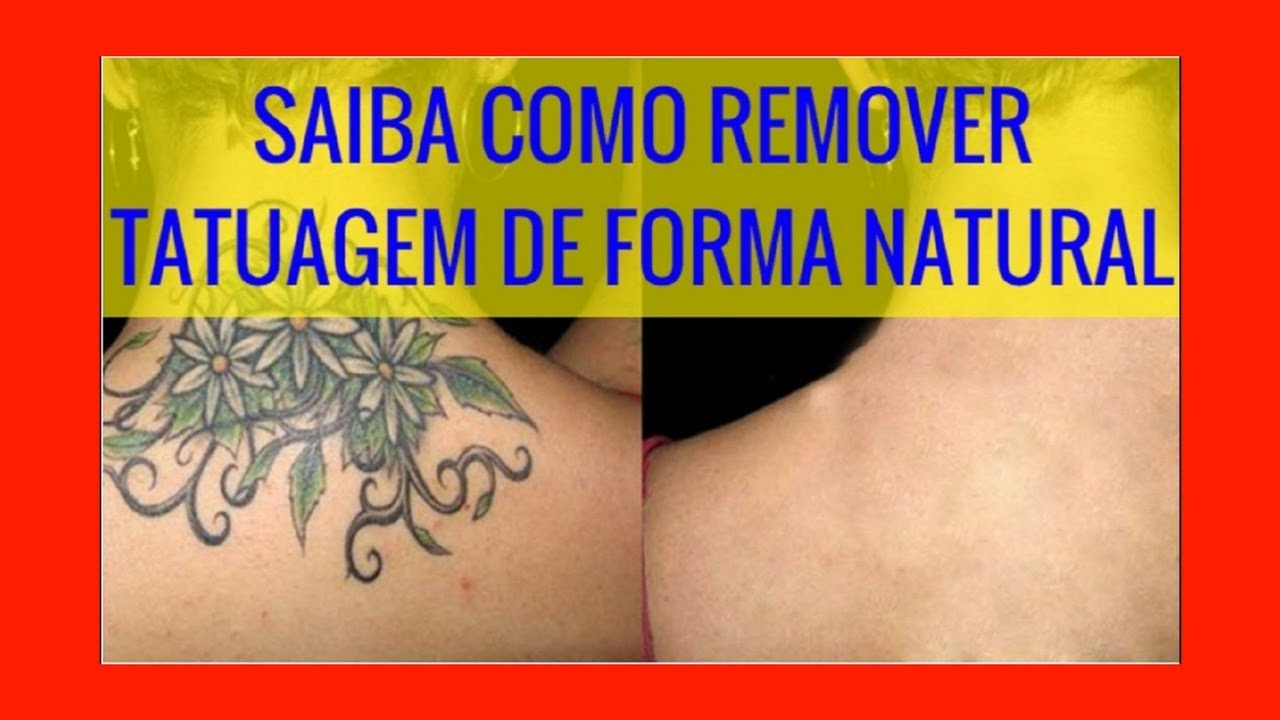 Como Tirar Tatuagem Do Corpo - Aprenda Como Apagar Tatuagem Do Corpo ...