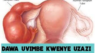 DAWA KUONDOA UVIMBE KWENYE KIZAZI || FIBROSIS HERBAL TREATMENT