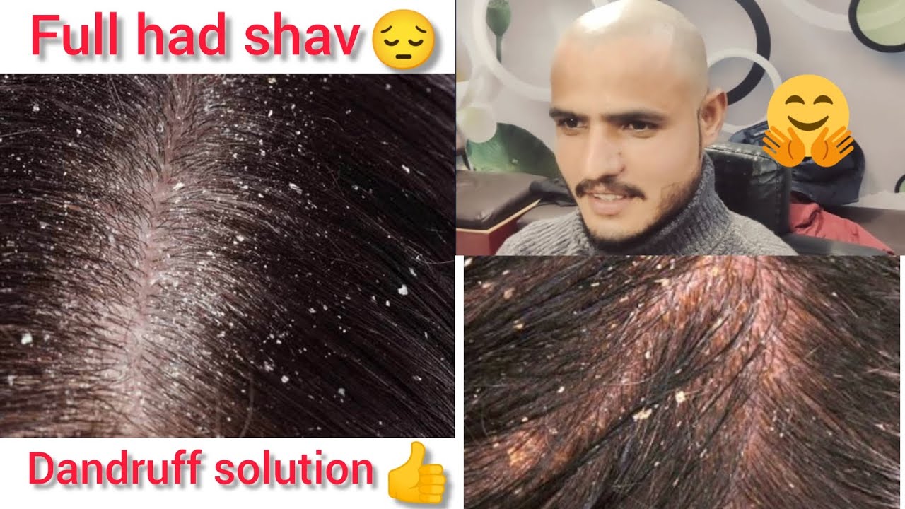 headshave ️/how to do dandruff😲 head shave/in Hindi)how to do head