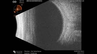 20 MHz Annular Ophthalmic Ultrasound ABSolu, Feeble intensity subhyaloid hemorrhage, 36564
