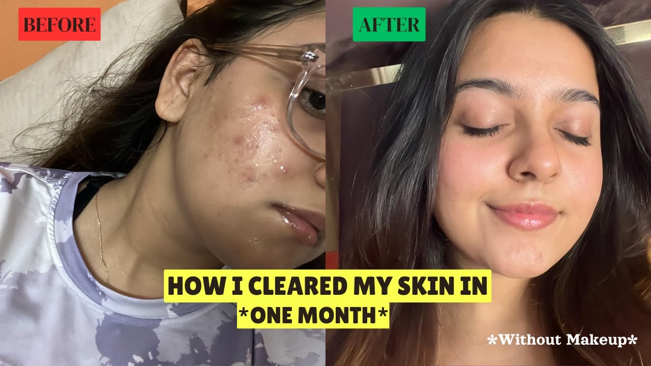 HOW I CLEARED MY ACNE IN JUST ONE MONTH *Simple & Effective* | Products ...