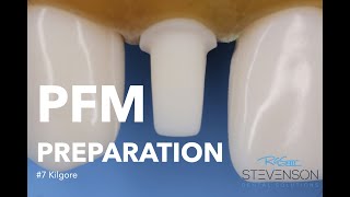 PFM Preparation on Tooth #7 Kilgore | Stevenson Dental Solutions