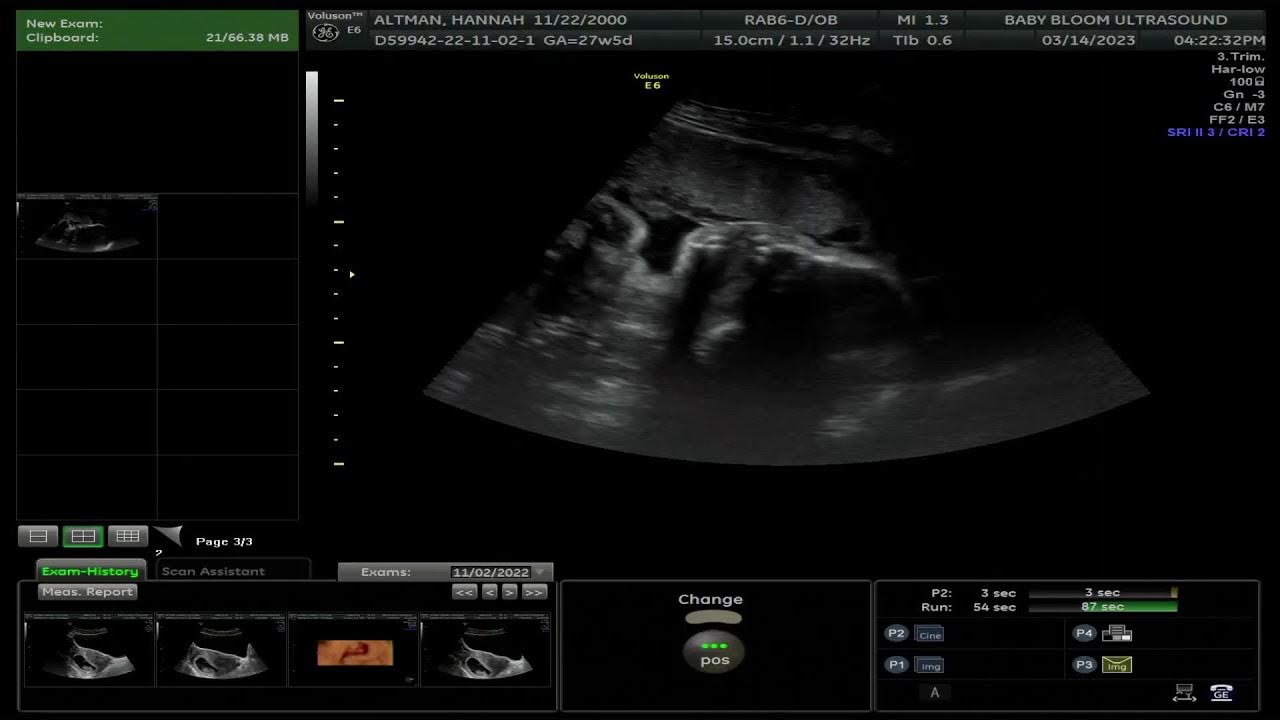 Baby bloom ultrasound live stream youtube