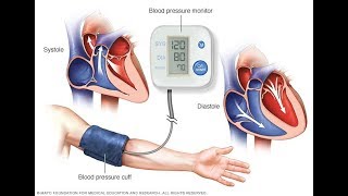 High Blood Pressure | Hypertension | Medical Wikipedia