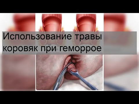 Использование травы коровяк при геморрое